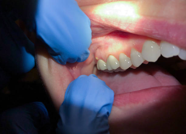 Best Emergency Root Canal Treatment in Midlothian, IL